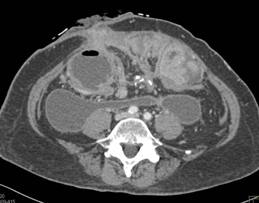 Small Bowel Obstruction due to Tumor with Carcinomatosis - CTisus CT Scan