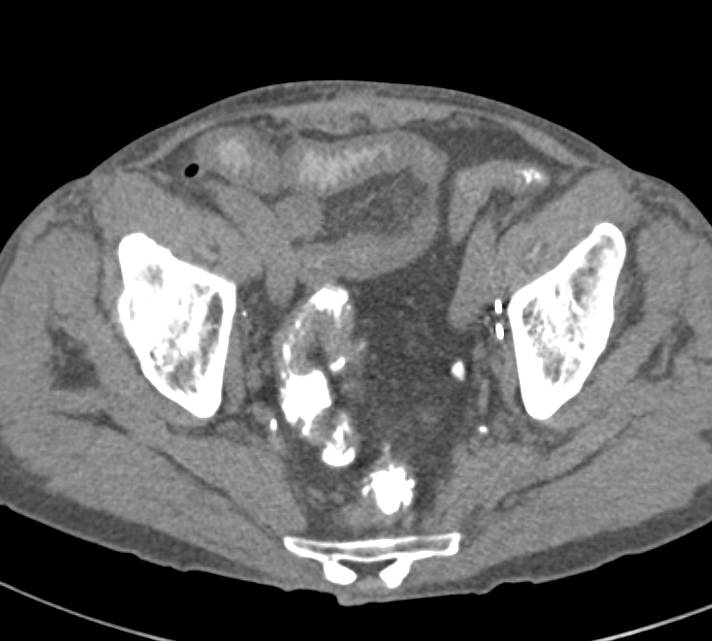 Thickened Small Bowel due to Enteritis - CTisus CT Scan