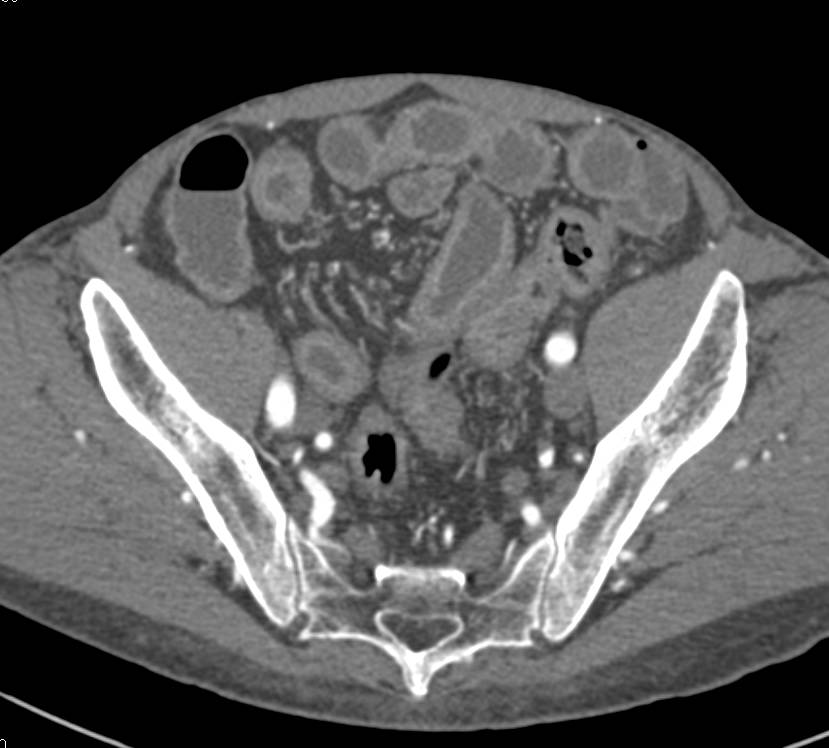 Beautiful Example of Active Crohn's Disease with Prominent Vasa Recta to Cecum - CTisus CT Scan