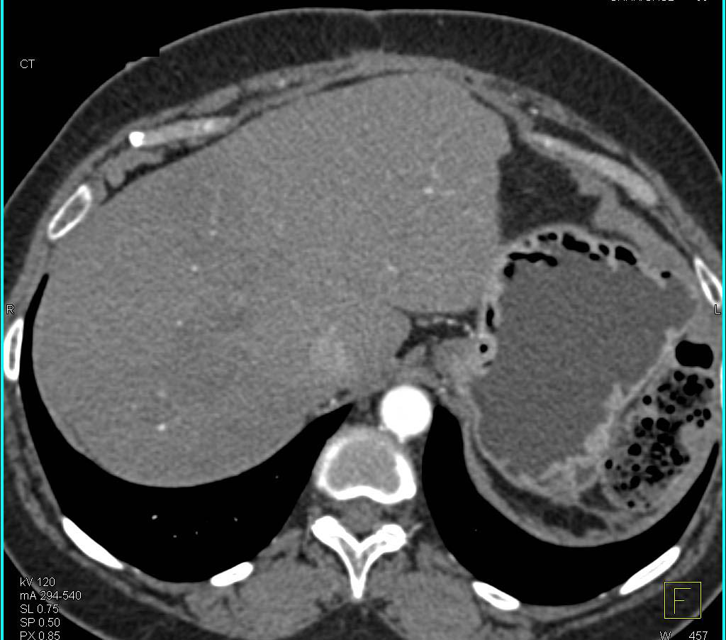 Duodenal Carcinoid Tumors and Pancreatic Intraductal Papillary Mucinous Neoplasm (IPMN) - CTisus CT Scan