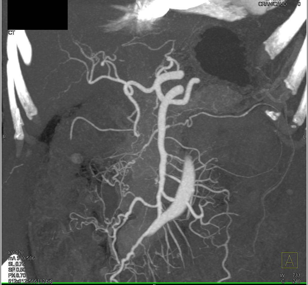 Carcinoid Tumor Extending Through Root of the Mesentery Encasing the Superior Mesenteric Artery (SMA) and Superior Mesenteric Vein (SMV) - CTisus CT Scan