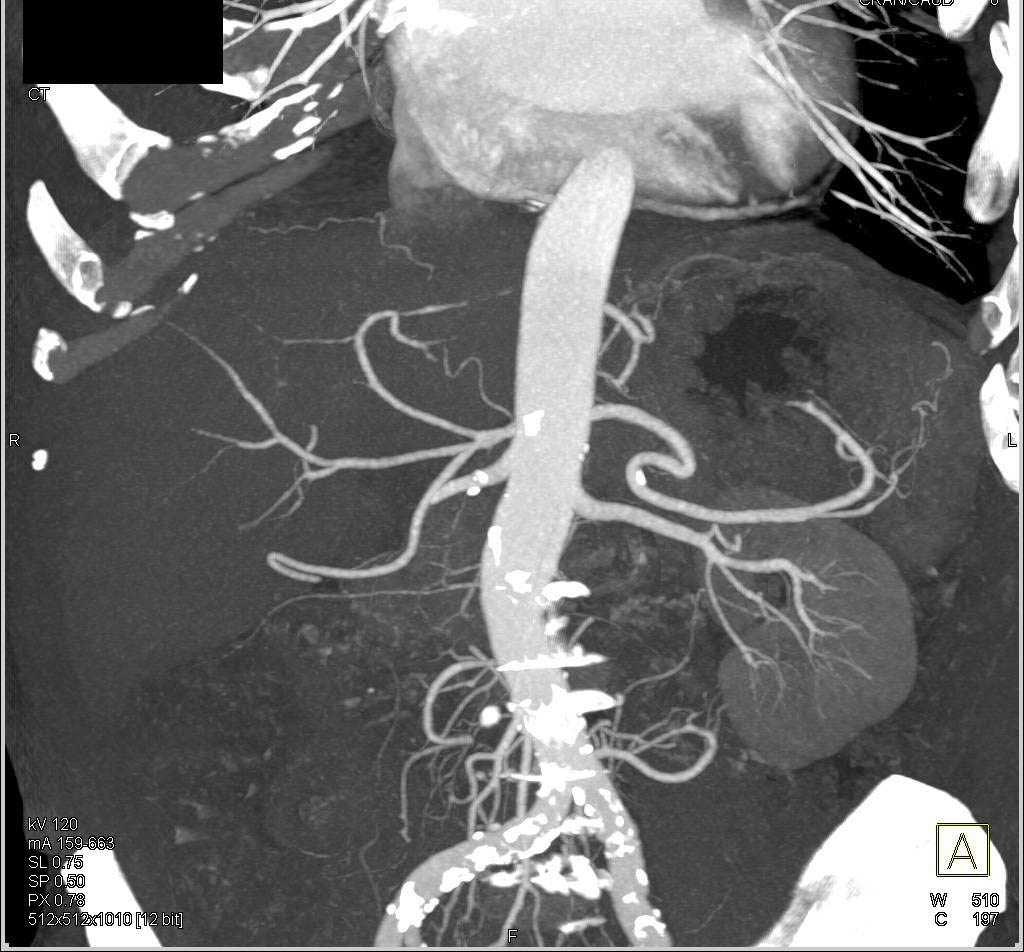 Duodenal Carcinoma - CTisus CT Scan