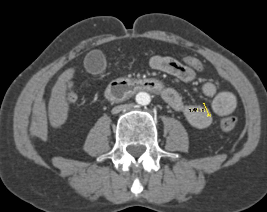 Crohn's Disease Involves the Duodenum - CTisus CT Scan