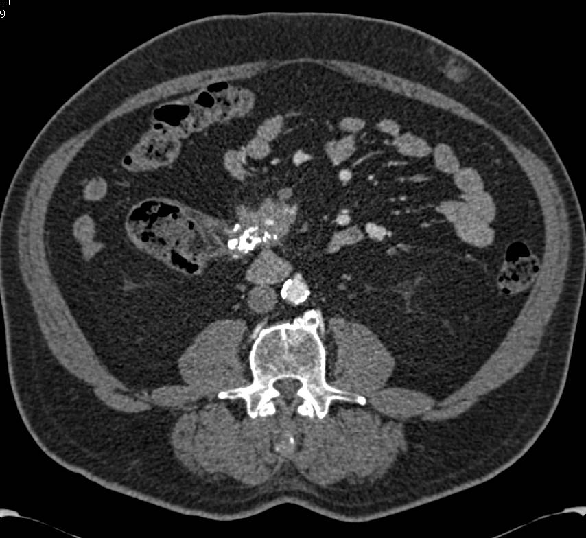 Carcinoid Tumor with Desmoplastic Reaction in the Mesentery - CTisus CT Scan