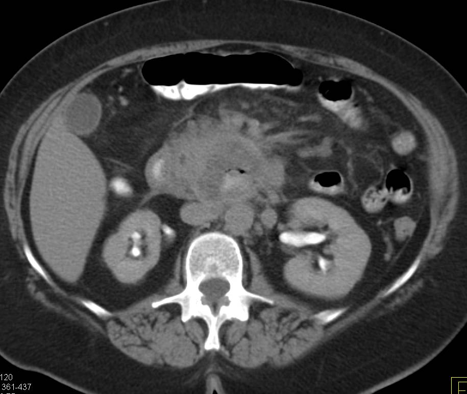 Ulcerating Duodenum Carcinoma - CTisus CT Scan