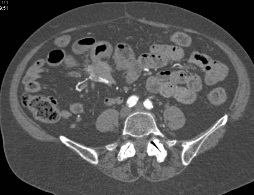 Carcinoid Tumor in Mesentery in RLQ with Desmoplastic Reaction and Beautiful CTA - CTisus CT Scan