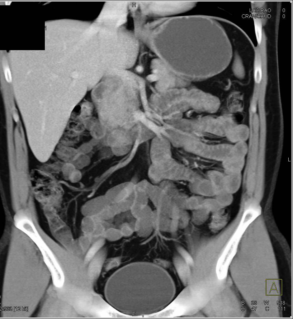 CT Appearance of the Small Bowel with VolLumen - CTisus CT Scan