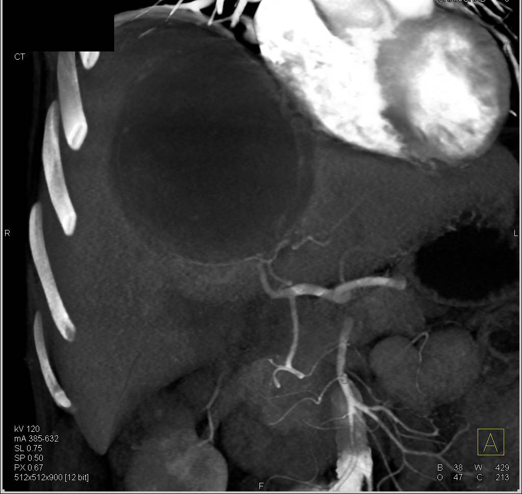 Small Bowel GIST Tumor Metastatic to the Liver with Cystic Liver Metastases - CTisus CT Scan