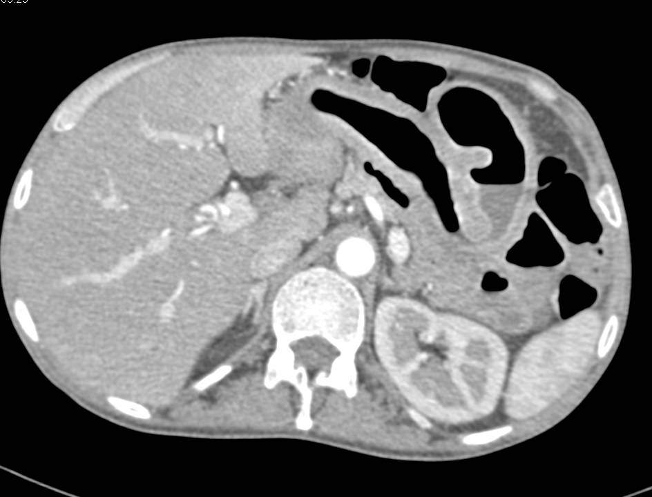 Small Bowel Obstruction due to Crohn's Disease in Distal Ileum - CTisus CT Scan