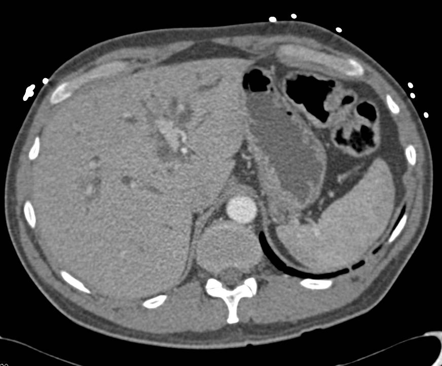 Gastroduodenal Artery (GDA) Pseudoaneurysm - CTisus CT Scan