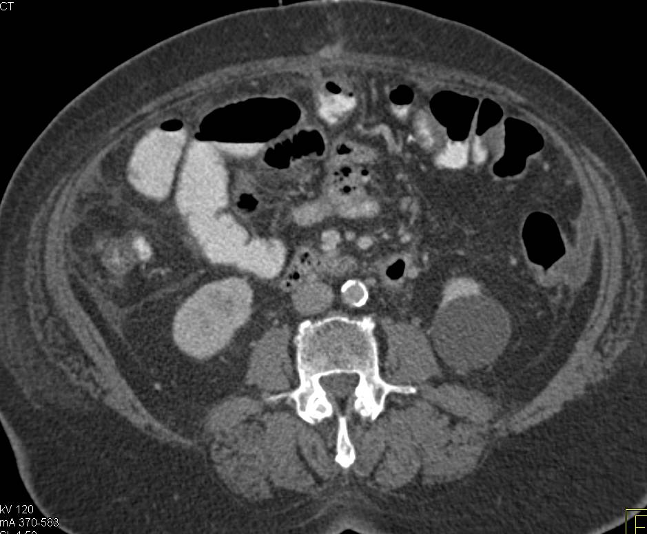 Thick Small Bowel Loops due to Ischemia - CTisus CT Scan