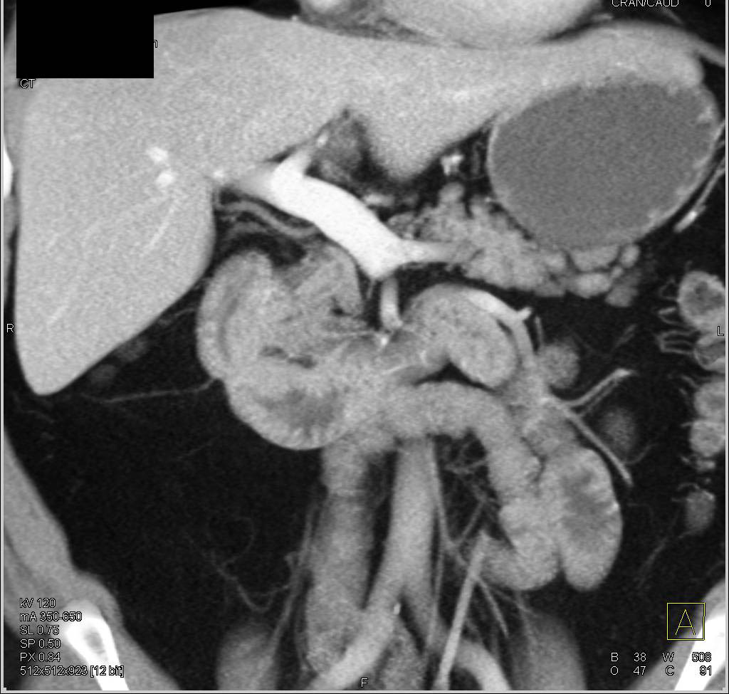 Duodenal Adenocarcinoma - CTisus CT Scan