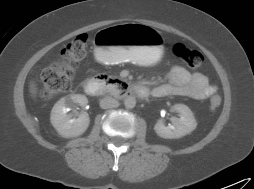 Duodenal Ulcer with Perforation - CTisus CT Scan