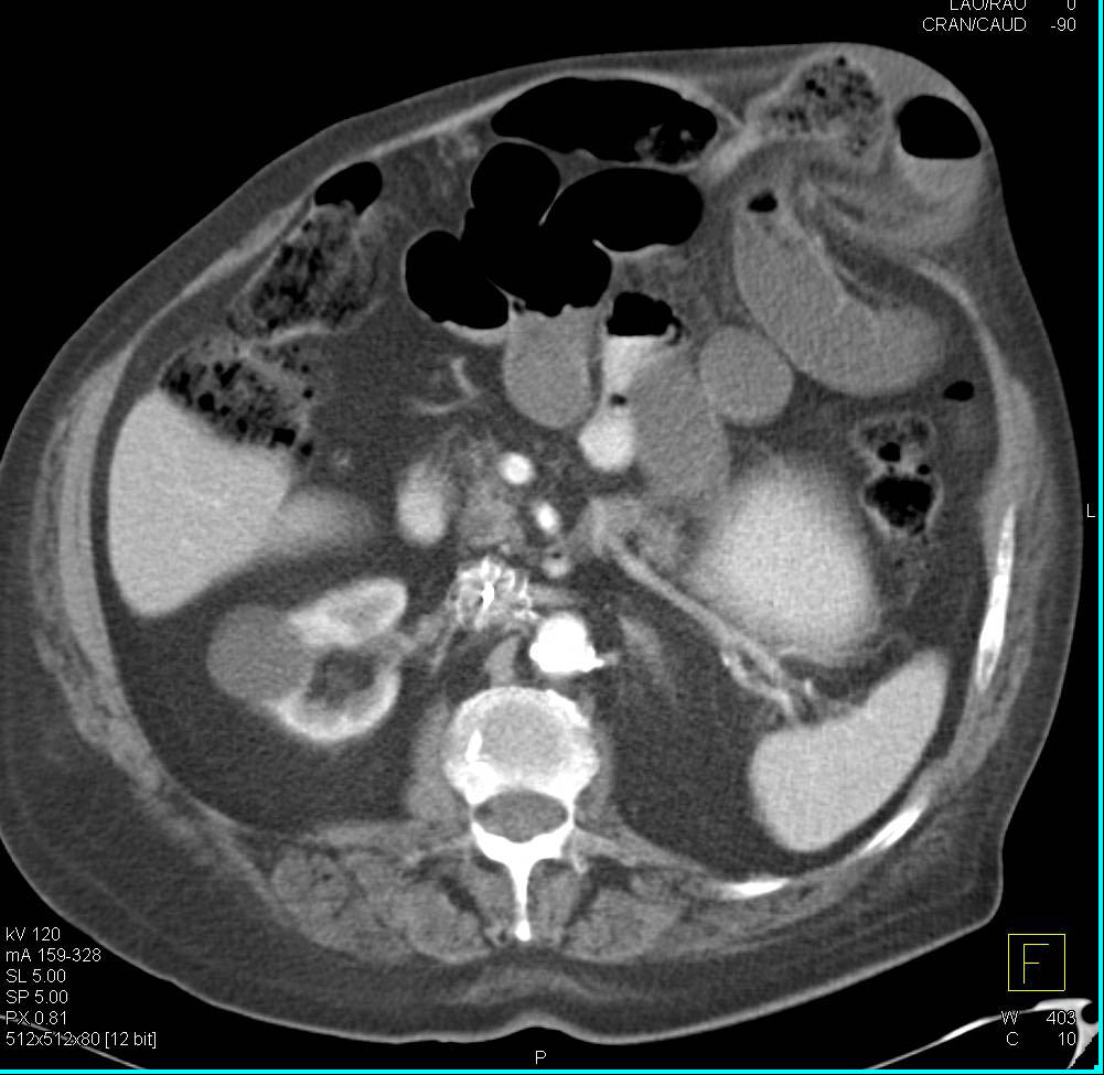 Incarcerated Hernia Left Flank in a Prior Trocar Site - CTisus CT Scan