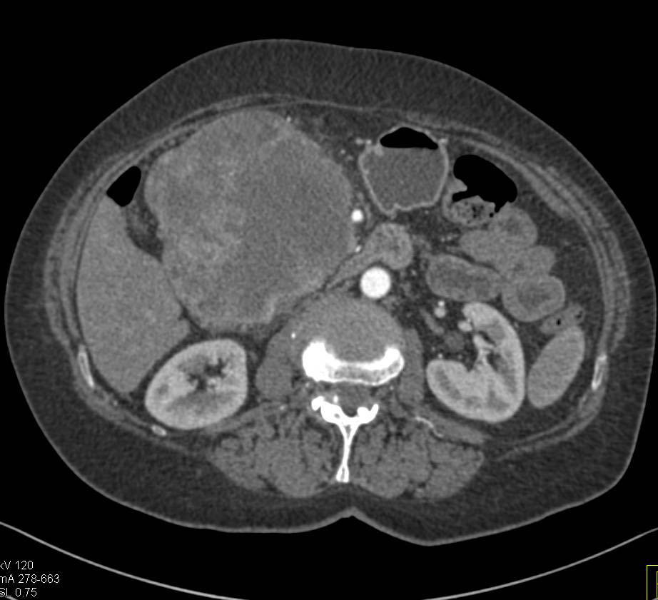 Duodenal GIST Tumor - CTisus CT Scan