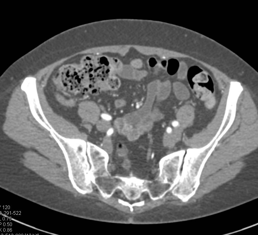 Acute Appendicitis - CTisus CT Scan