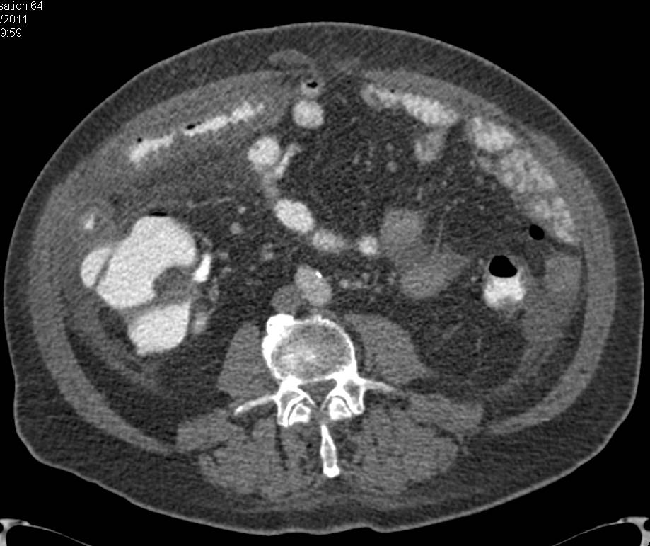 Ischemic Enteritis - CTisus CT Scan