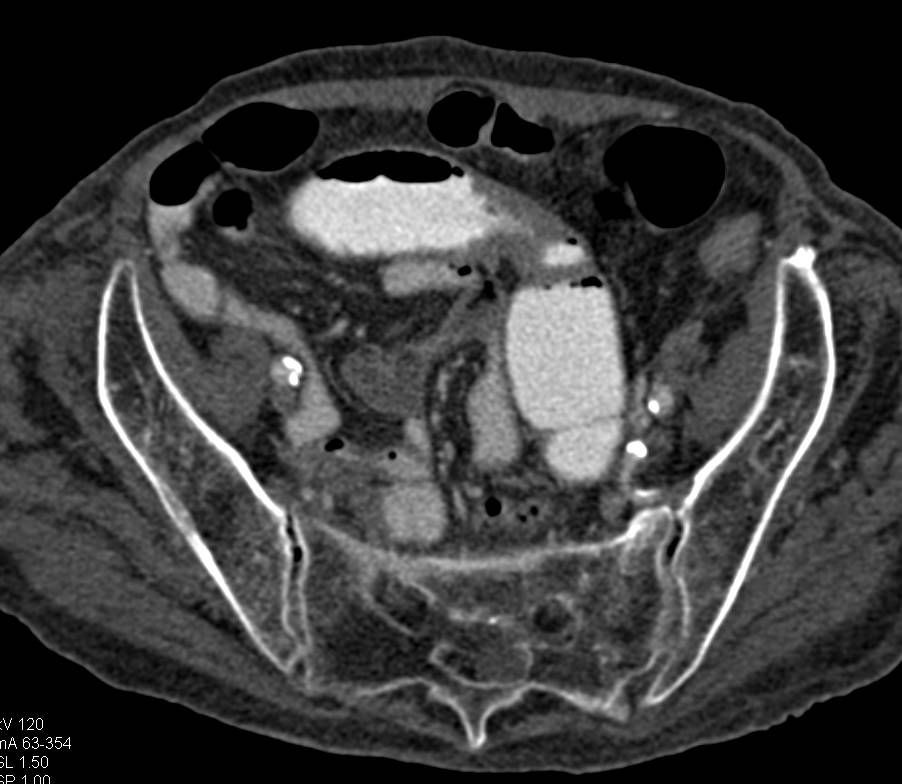 Metastatic Renal Cell Carcinoma to the Small Bowel Nicely Defined - CTisus CT Scan