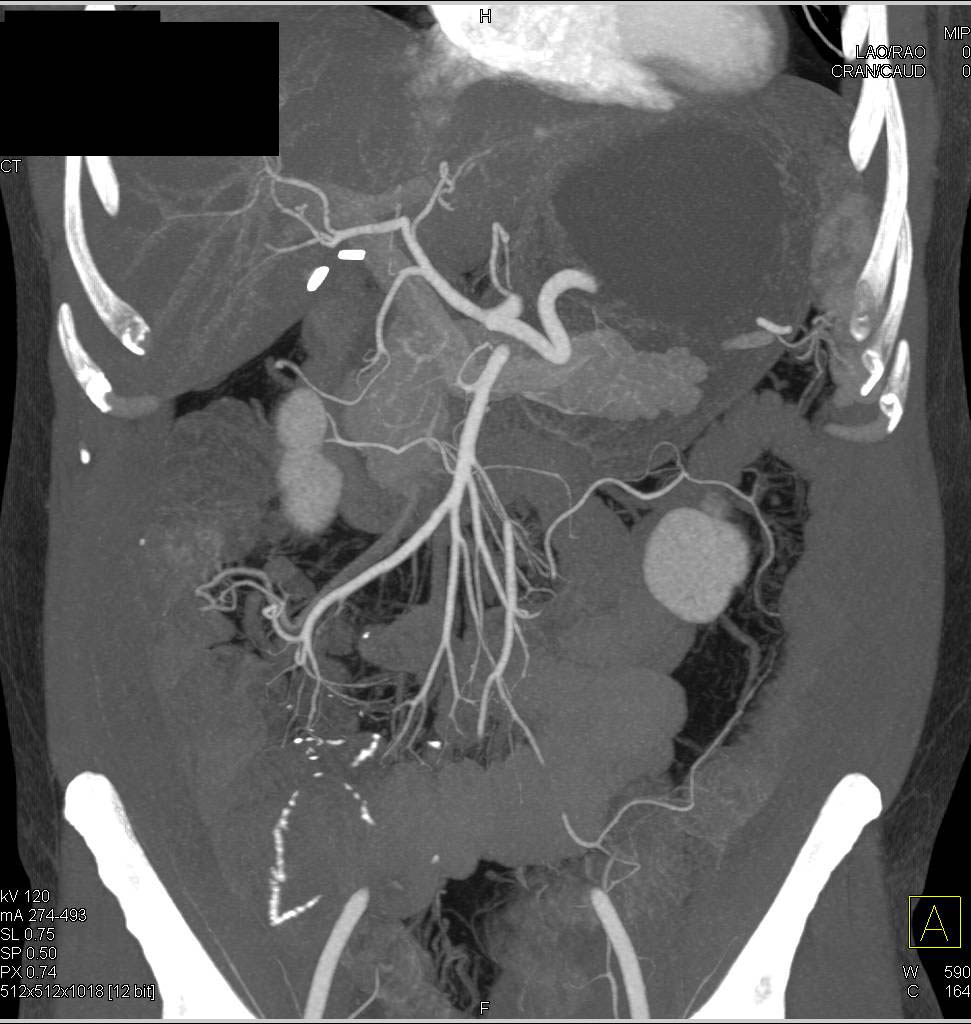 CTA of Crohn's Disease with Prior Resections - CTisus CT Scan