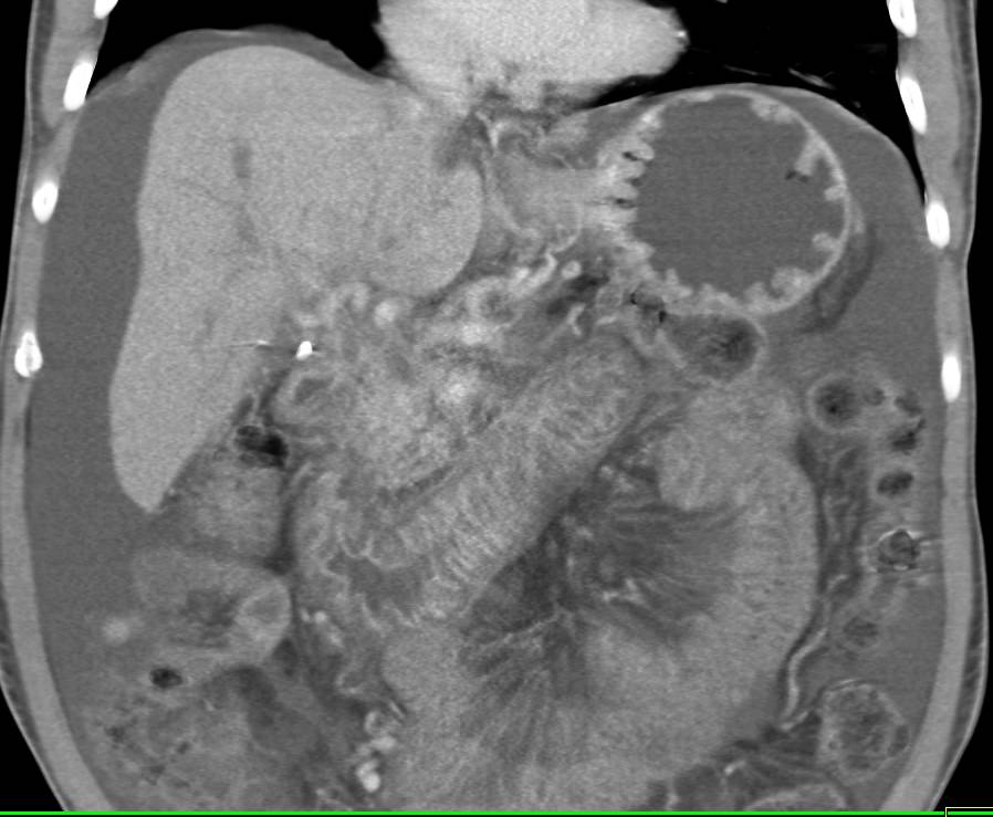 Wet Bowel Pattern due to Enteritis - CTisus CT Scan