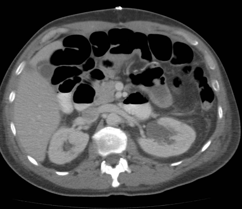 Small Bowel Obstruction with Adhesions - CTisus CT Scan