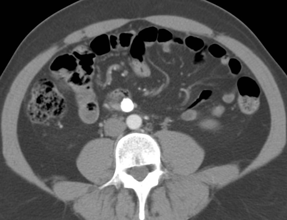 Cystic Carcinoid Tumor - CTisus CT Scan