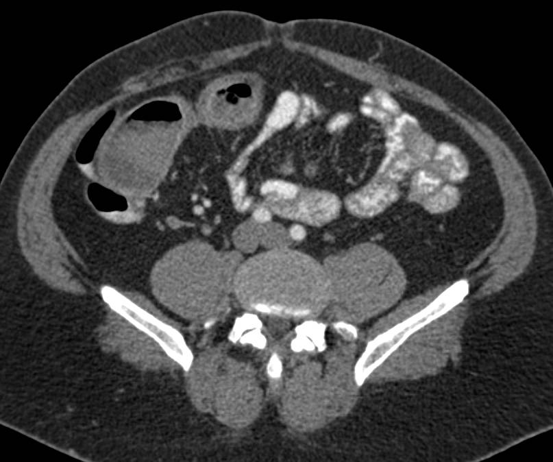 Crohn's Disease with Stricture of the Terminal Ileum - CTisus CT Scan