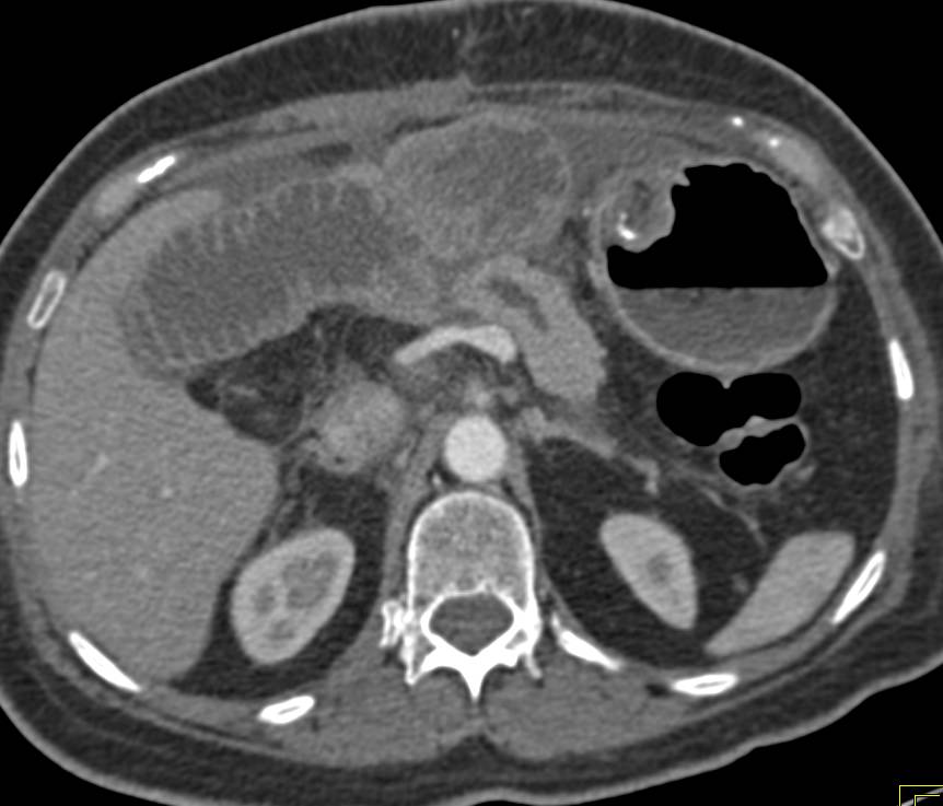 Dilated Small Bowel in A Patient with a Prior Whipple Procedure - CTisus CT Scan