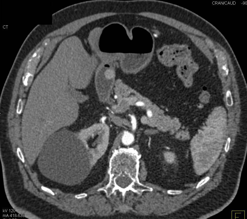 1 cm Carcinoid Tumor in the Duodenum - CTisus CT Scan