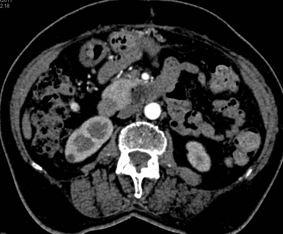 Duodenal Diverticulum Simulates a Pancreatic Mass - CTisus CT Scan