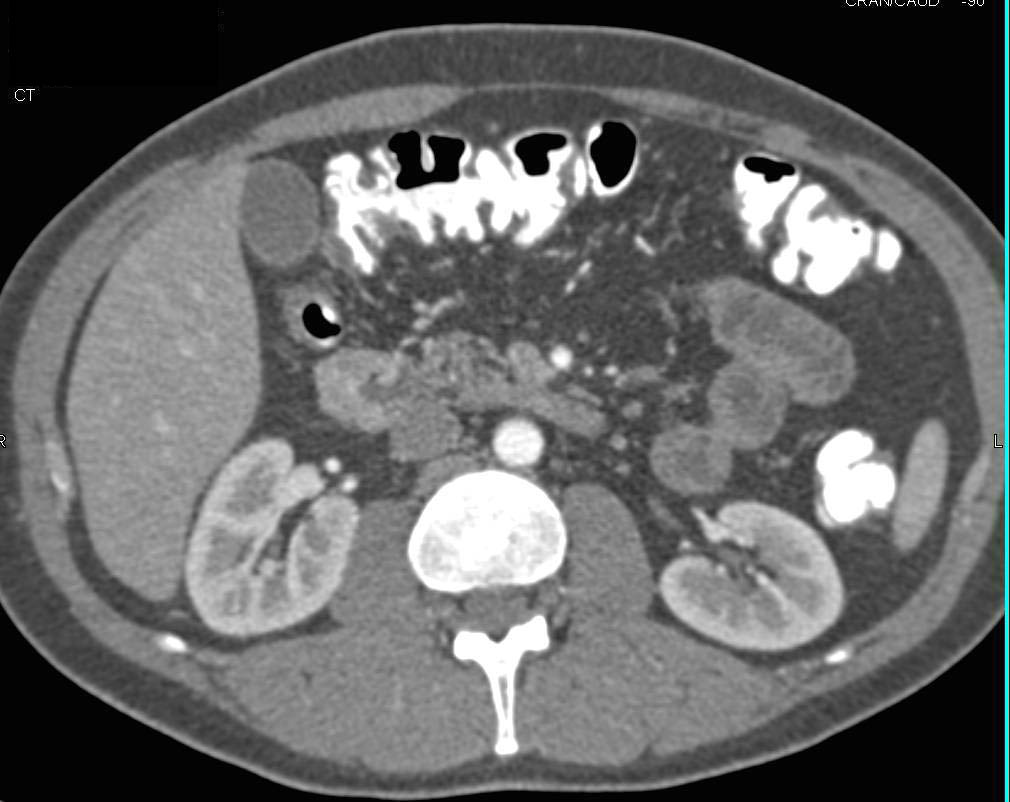 2 cm Carcinoid Tumor (enhancing) in Second Portion of the Duodenum - CTisus CT Scan