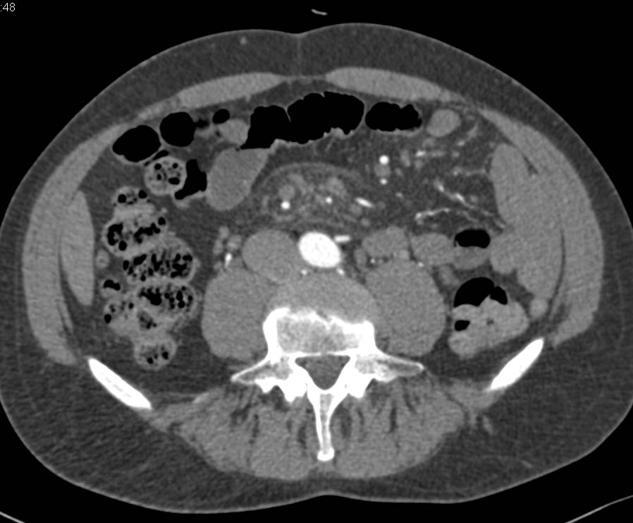 Mesenteric Nodes due to Prior Infection - CTisus CT Scan