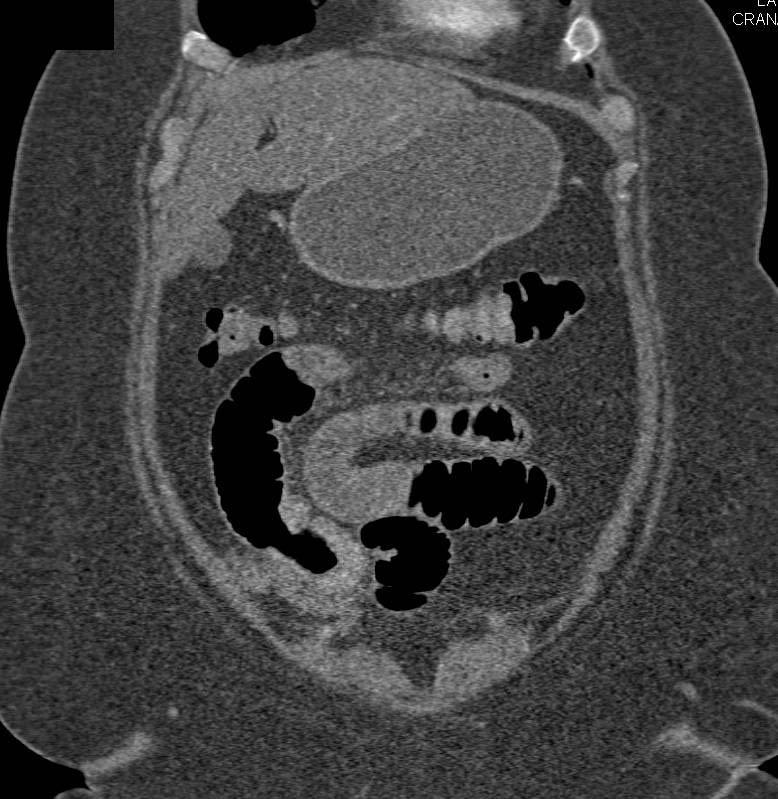 Small Bowel Adenocarcinoma Causes Small Bowel Obstruction (SBO) - CTisus CT Scan