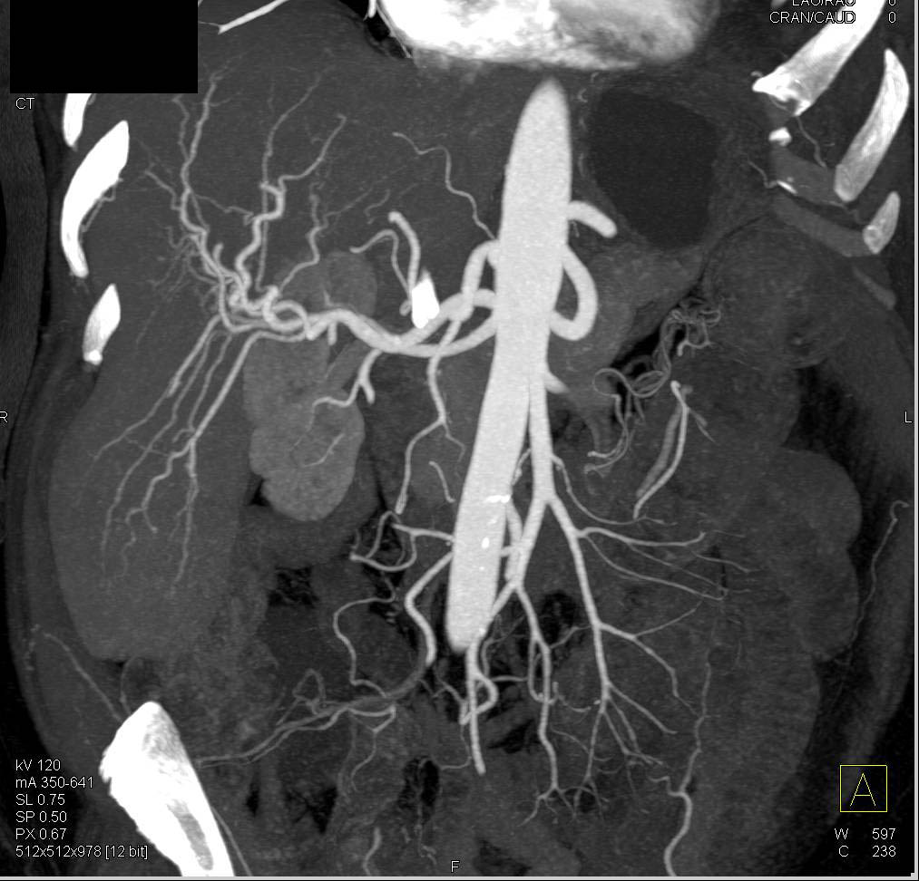Entero-enteric Fistulae in Left Lower Quadrant - CTisus CT Scan