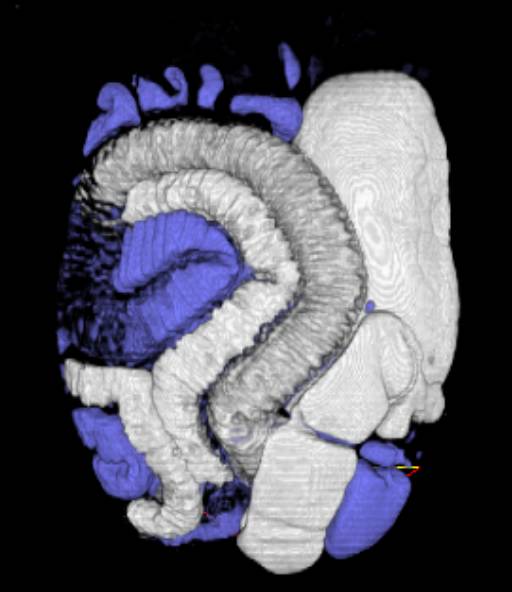 Pneumatosis Small Bowel in Scleroderma - CTisus CT Scan