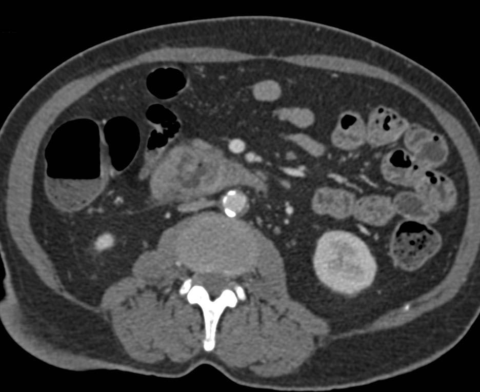 Duodenal Adenocarcinoma - CTisus CT Scan