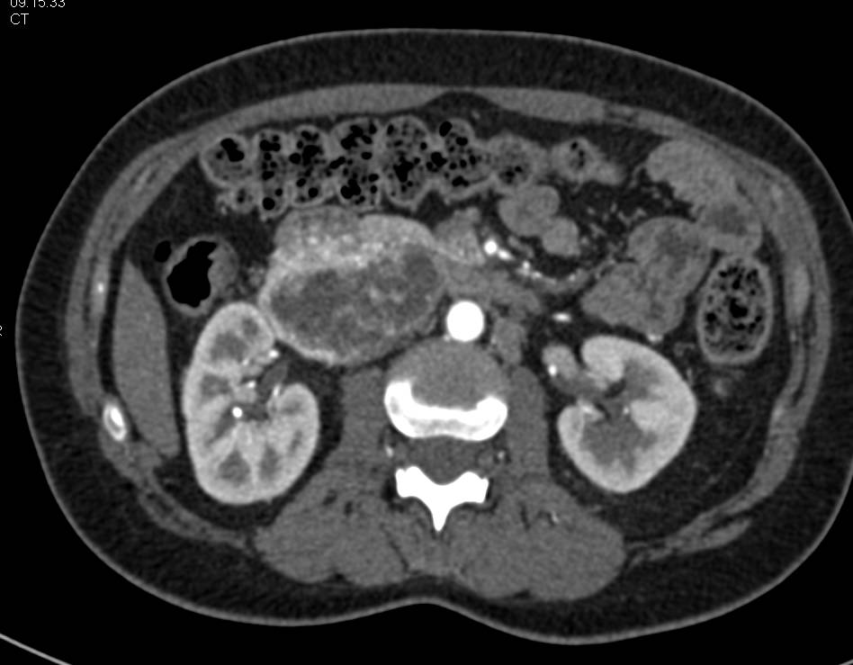 Duodenal GIST Tumor that Simulates a Neuroendocrine Tumor - CTisus CT Scan