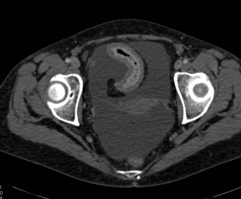 Ischemic Small Bowel in a Patient with Extensive Liver Metastases - CTisus CT Scan