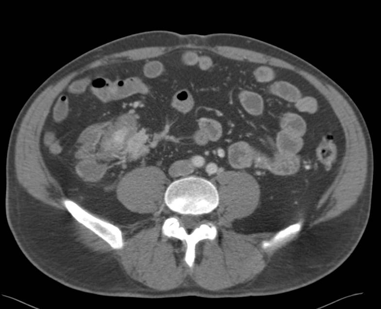 Carcinoid Tumor with Desmoplastic Reaction - CTisus CT Scan