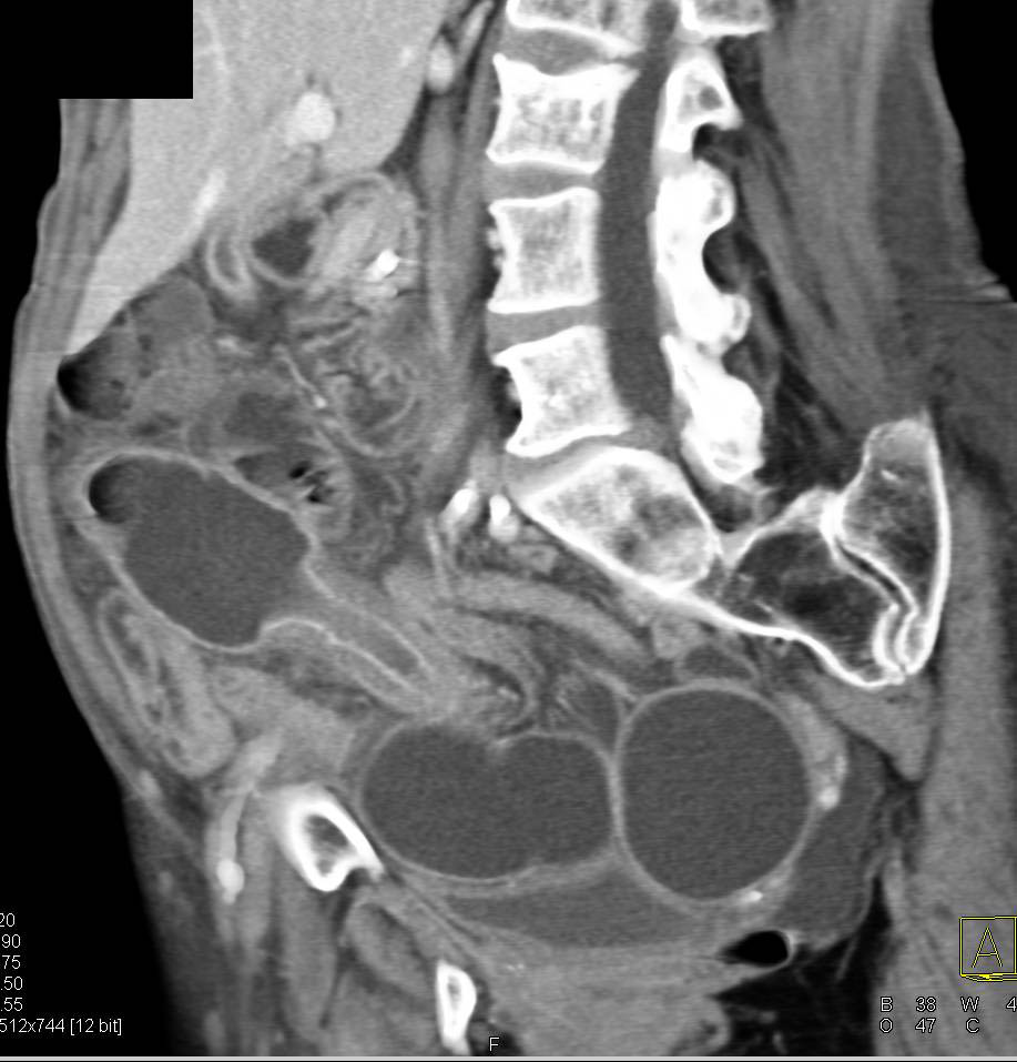 Crohn's Disease with a Stricture - CTisus CT Scan