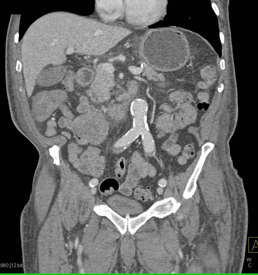 Carcinoid Tumor in Right Lower Quadrant - CTisus CT Scan