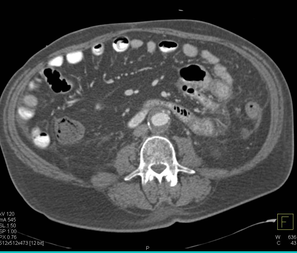 Ischemic Small Bowel - CTisus CT Scan