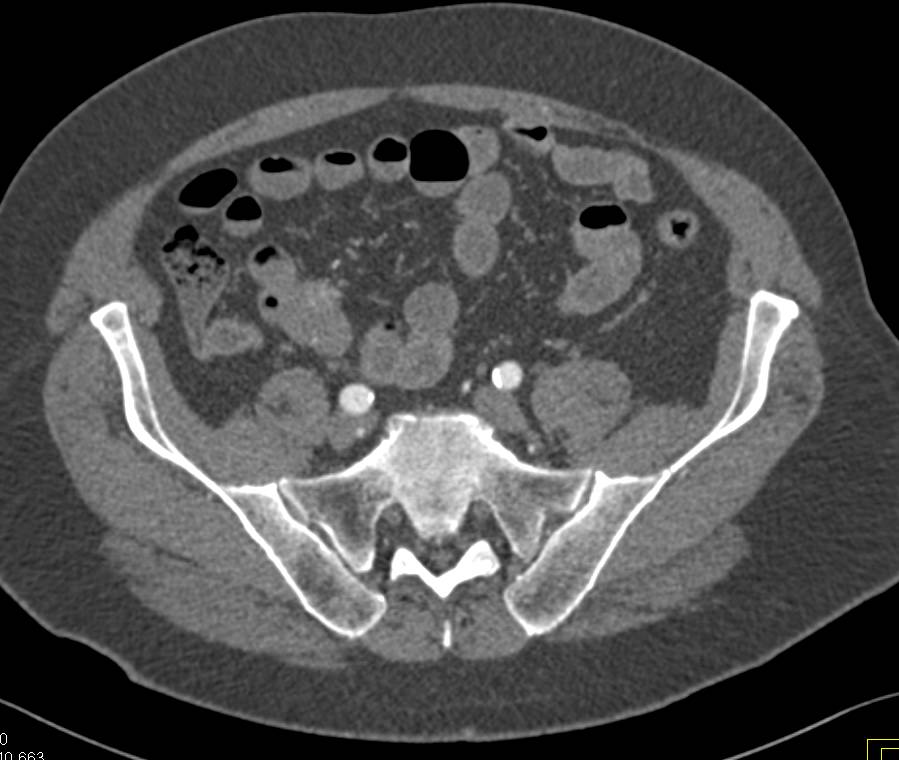 1 cm Carcinoid Tumor in RLQ with Desmoplastic Reaction - CTisus CT Scan