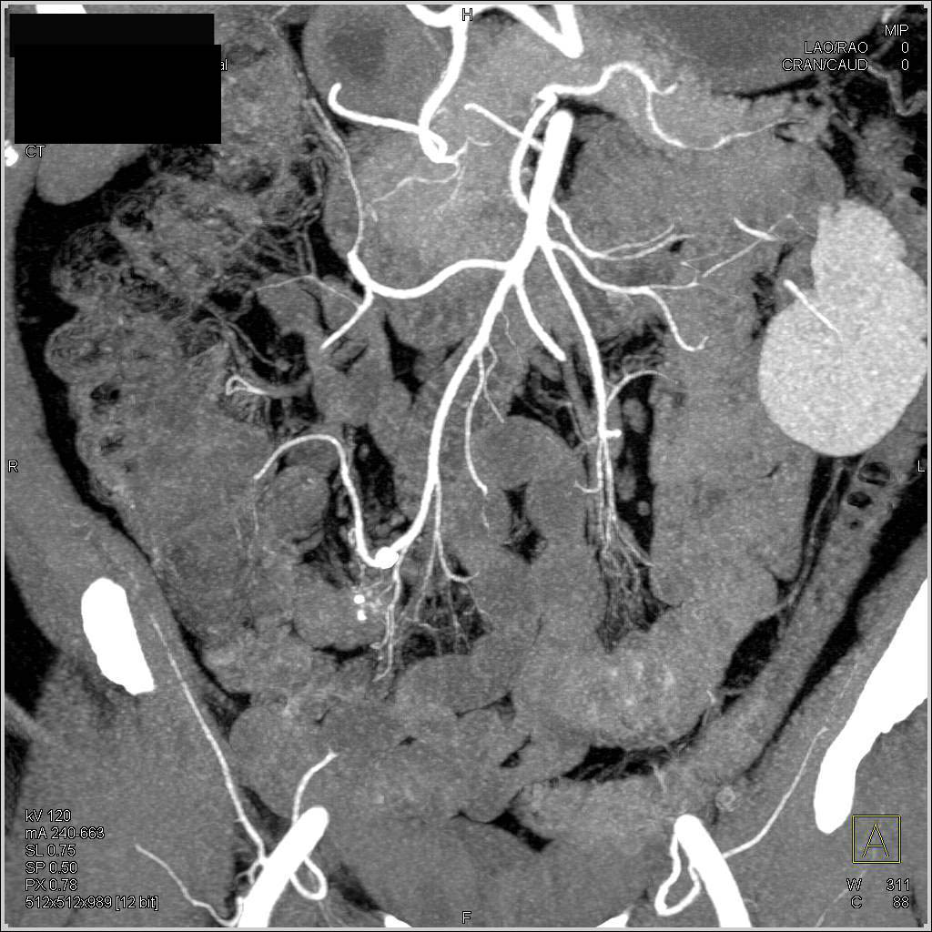 Subtle Carcinoid Tumor in the Terminal Ileum with Faint Calcification - CTisus CT Scan