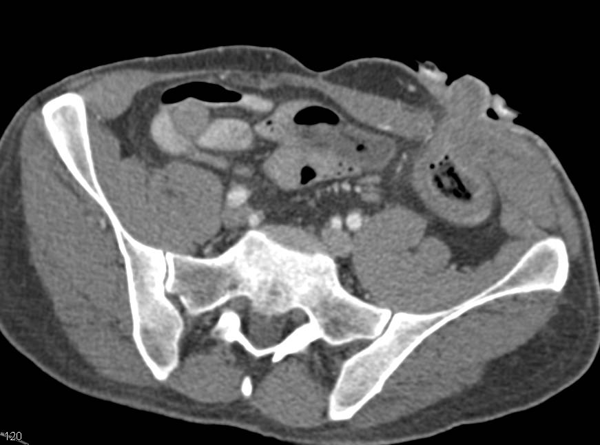 Crohn's with Stenosis at Osteomy Site with Feces Sign - CTisus CT Scan