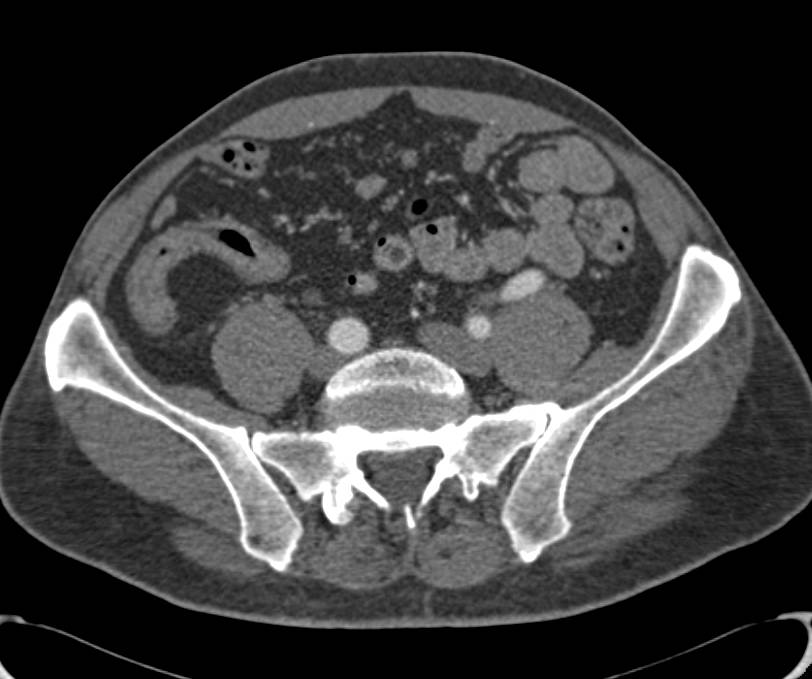 Crohn's Disease Involves the Terminal Ileum with Prominent Vasa Recta - CTisus CT Scan