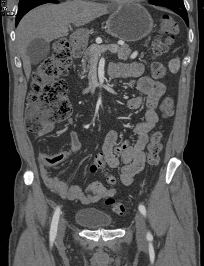 Crohn's Disease Involves the Terminal Ileum - CTisus CT Scan