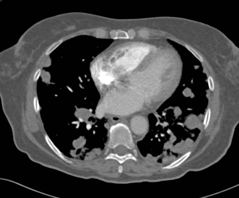 Angiosarcoma of the Small Bowel with Multiple Metastases - CTisus CT Scan