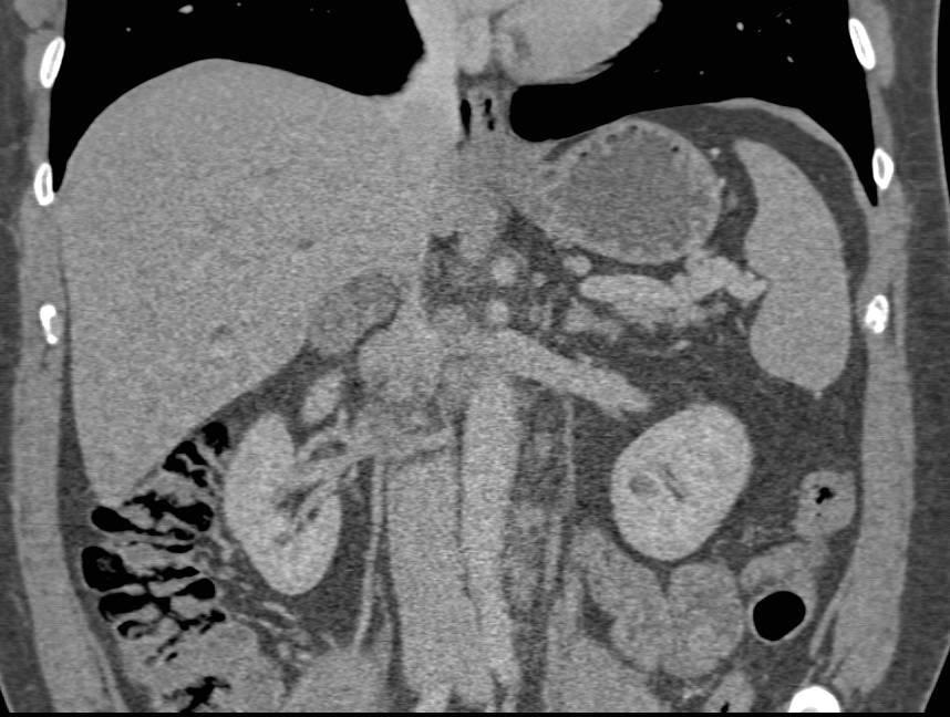 Adenocarcinoma of the Duodenum - CTisus CT Scan