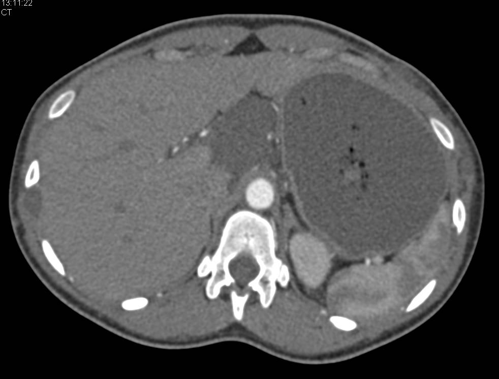 Impressive Case of Multi-organ Involvement by Neurofibromatosis Including mesentery - CTisus CT Scan